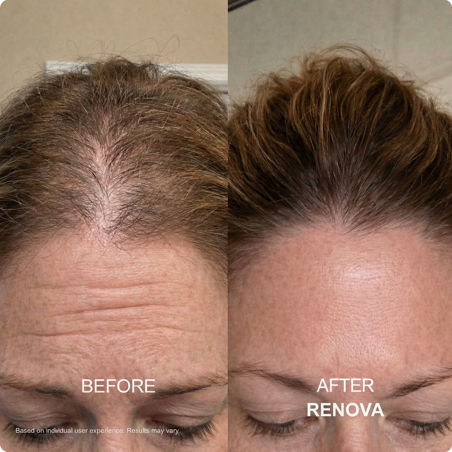 Peptide Hair Regrowth Micro Infusion Kit