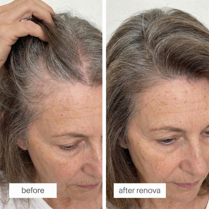 Peptide Hair Regrowth Micro Infusion Kit