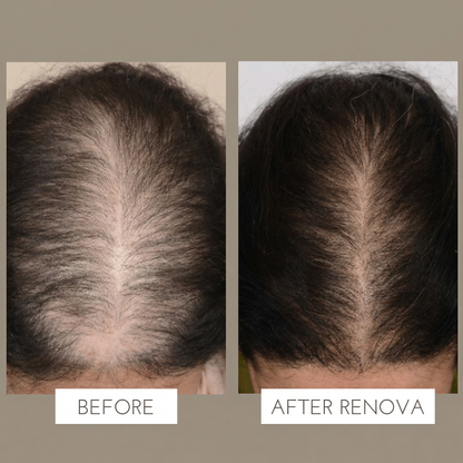 Peptide Hair Regrowth Micro Infusion Kit