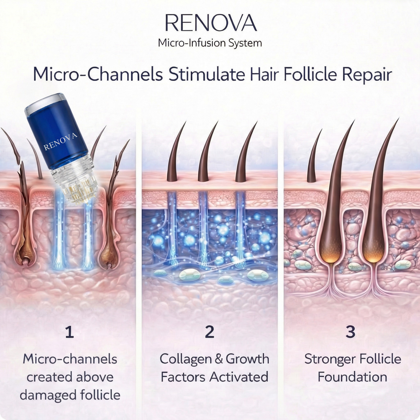 Peptide Hair Regrowth Micro Infusion Kit